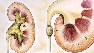 腎結石是怎么引起的？
